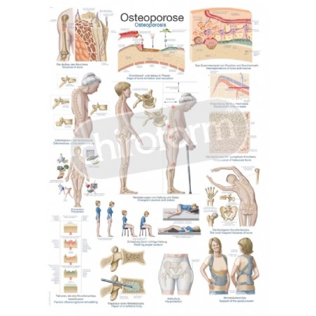 "Osteoporosis" - Anatomisk Plakat