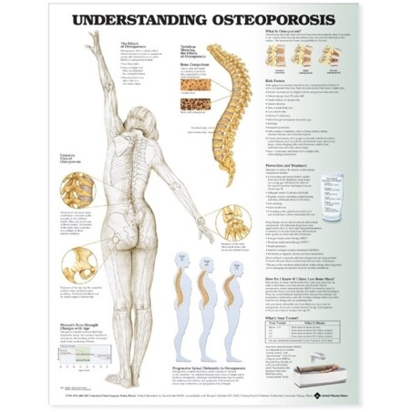 "Understanding Osteoporosis" - Anatomisk Plakat
