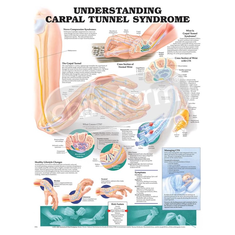 "Understanding Carpal Tunnel Syndrome" - Anatomisk Plakat