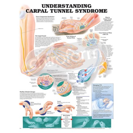 "Understanding Carpal Tunnel Syndrome" - Anatomisk Plakat