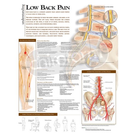 "Understanding Low Back Pain" - Anatomical Chart