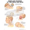 "Whiplash Injuries of the Head and Neck" - Anatomisk Plakat