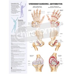 "Understanding Arthritis" - Anatomisk Plakat