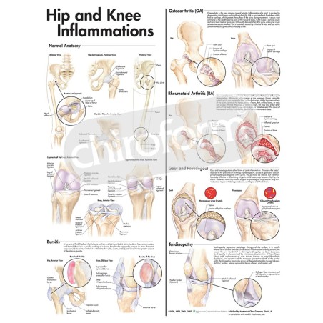 "Hip and Knee Inflammations" - Anatomisk Plakat