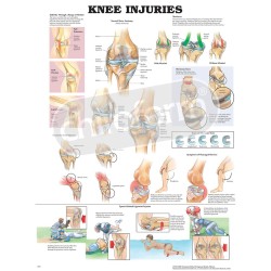 "Knee Injuries" - Anatomisk Plakat